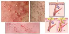 Tất tần tật những điều bạn cần biết về viêm lỗ chân lông